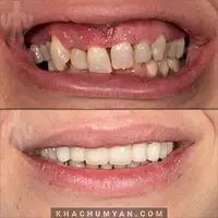 KHACHUMYAN Dental Clinic in Yerevan - Before and after - 12