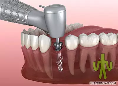 Процесс зубной имплантации