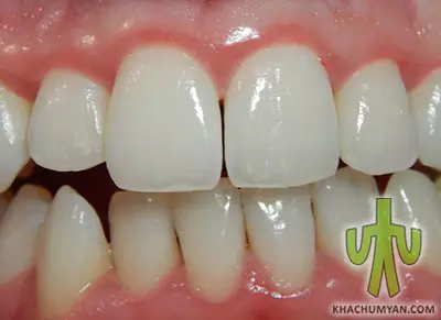 Gum disease - Gingivitis