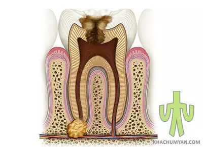 Ատամի կիստայի առաջացման պատճառները