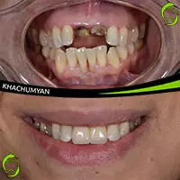 KHACHUMYAN Dental Clinic in Yerevan - Before and after - 1