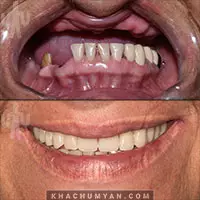 KHACHUMYAN Dental Clinic in Yerevan - Before and after - 10