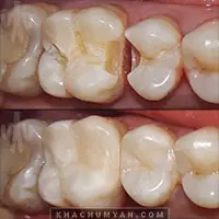 KHACHUMYAN Dental Clinic in Yerevan - Before and after - 11