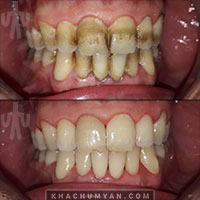 KHACHUMYAN Dental Clinic in Yerevan - Before and after - 13