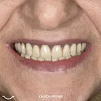 KHACHUMYAN Dental Clinic in Yerevan - Before and after - 16