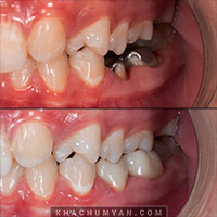 KHACHUMYAN Dental Clinic in Yerevan - Before and after - 17