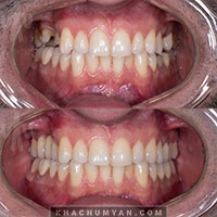 KHACHUMYAN Dental Clinic in Yerevan - Before and after - 19
