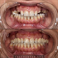 KHACHUMYAN Dental Clinic in Yerevan - Before and after - 20