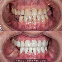 KHACHUMYAN Dental Clinic in Yerevan - Before and after - 21