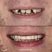 KHACHUMYAN Dental Clinic in Yerevan - Before and after - 3