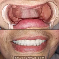 KHACHUMYAN Dental Clinic in Yerevan - Before and after - 4
