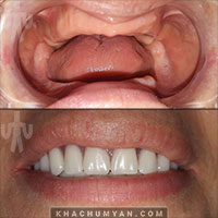 KHACHUMYAN Dental Clinic in Yerevan - Before and after - 5