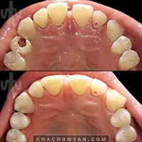 KHACHUMYAN Dental Clinic in Yerevan - Before and after - 6