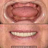 KHACHUMYAN Dental Clinic in Yerevan - Before and after - 7