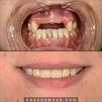 KHACHUMYAN Dental Clinic in Yerevan - Before and after - 8