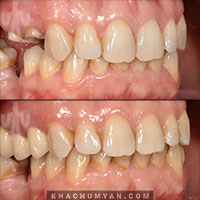 KHACHUMYAN Dental Clinic in Yerevan - Before and after - 9