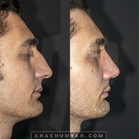 KHACHUMYAN Rhinoplasty - Nose Surgery - 1