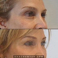 KHACHUMYAN Blepharoplasty - Eyelids Surgery - 1