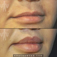 KHACHUMYAN Lips Surgery - 4